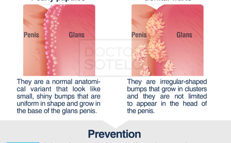 Genital warts