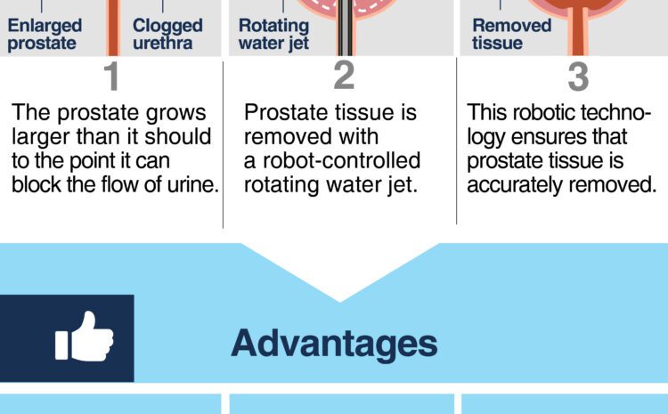  Alternatives for the treatment of benign prostatic hyperplasia: Aquablation